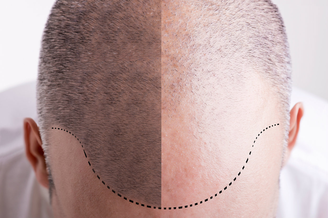 prendre soins du cuir chevelu et éviter l'eczéma